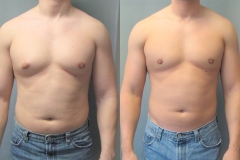 thumbs_Before-After-Gynecomastia-Pic